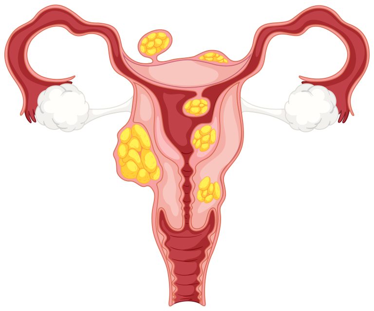 Diagram of sub serosal uterine fibroids